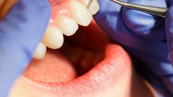 ציפוי זירקוניה